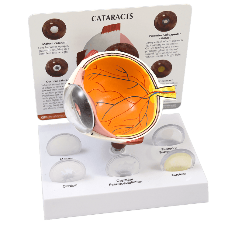 Good-Lite Cataract Eye Model