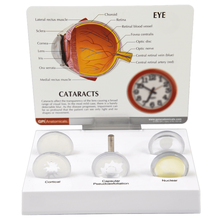 Good-Lite Cataract Eye Model