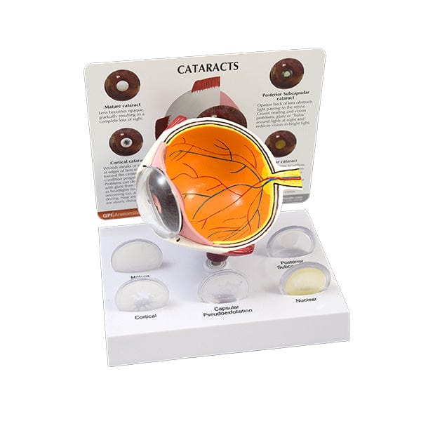 Good-Lite Co Cataract Eye Model