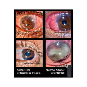 Good-Lite Co QuikVue Anterior Segment Imaging Adaptor