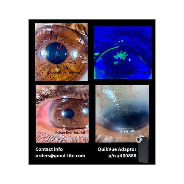 Good-Lite Co QuikVue Anterior Segment Imaging Adaptor