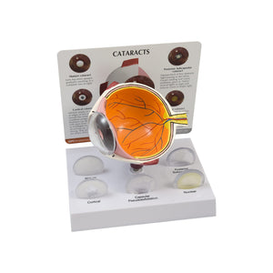 Good-Lite Educational Tools Eye Model: Cataract