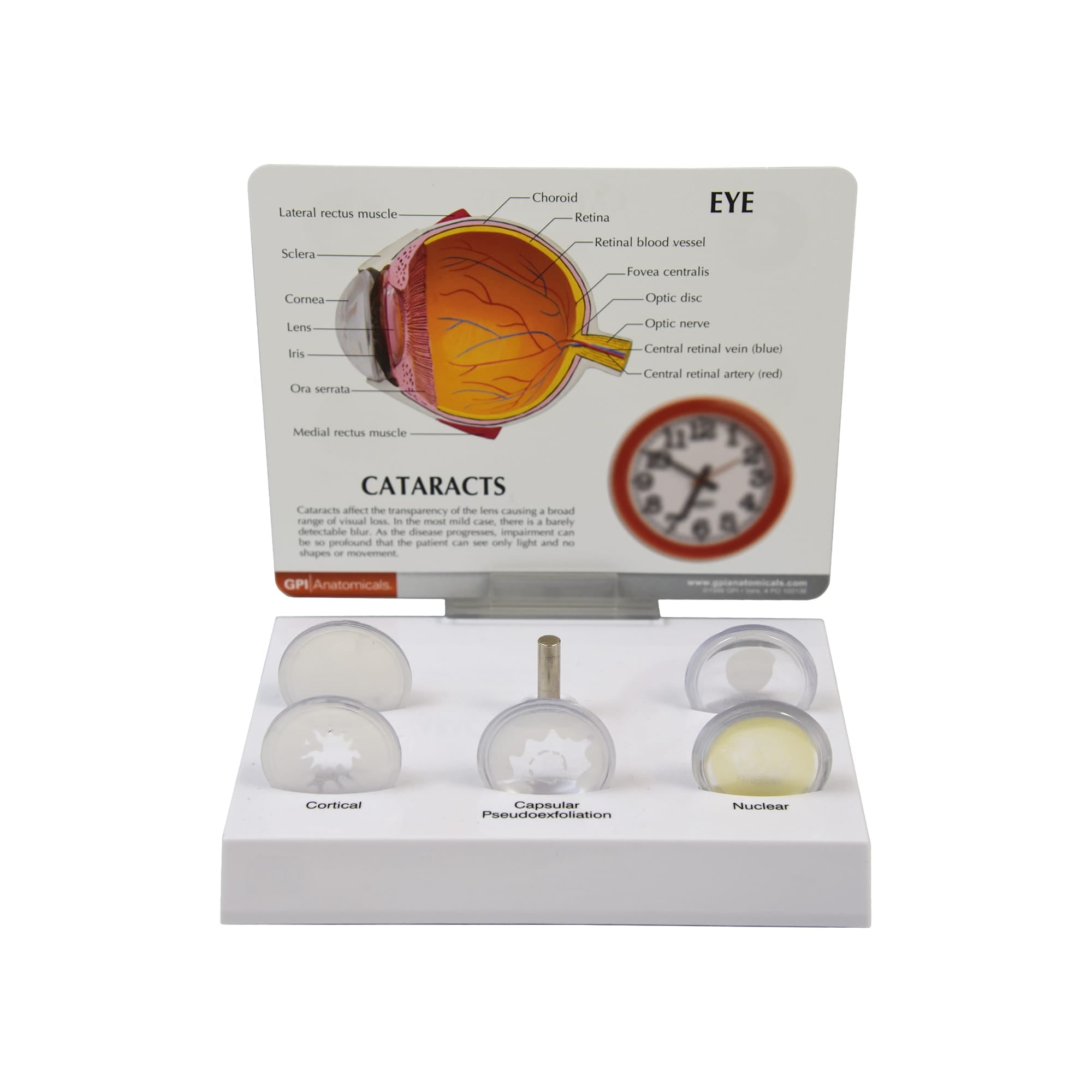 Good-Lite Educational Tools Eye Model: Cataract