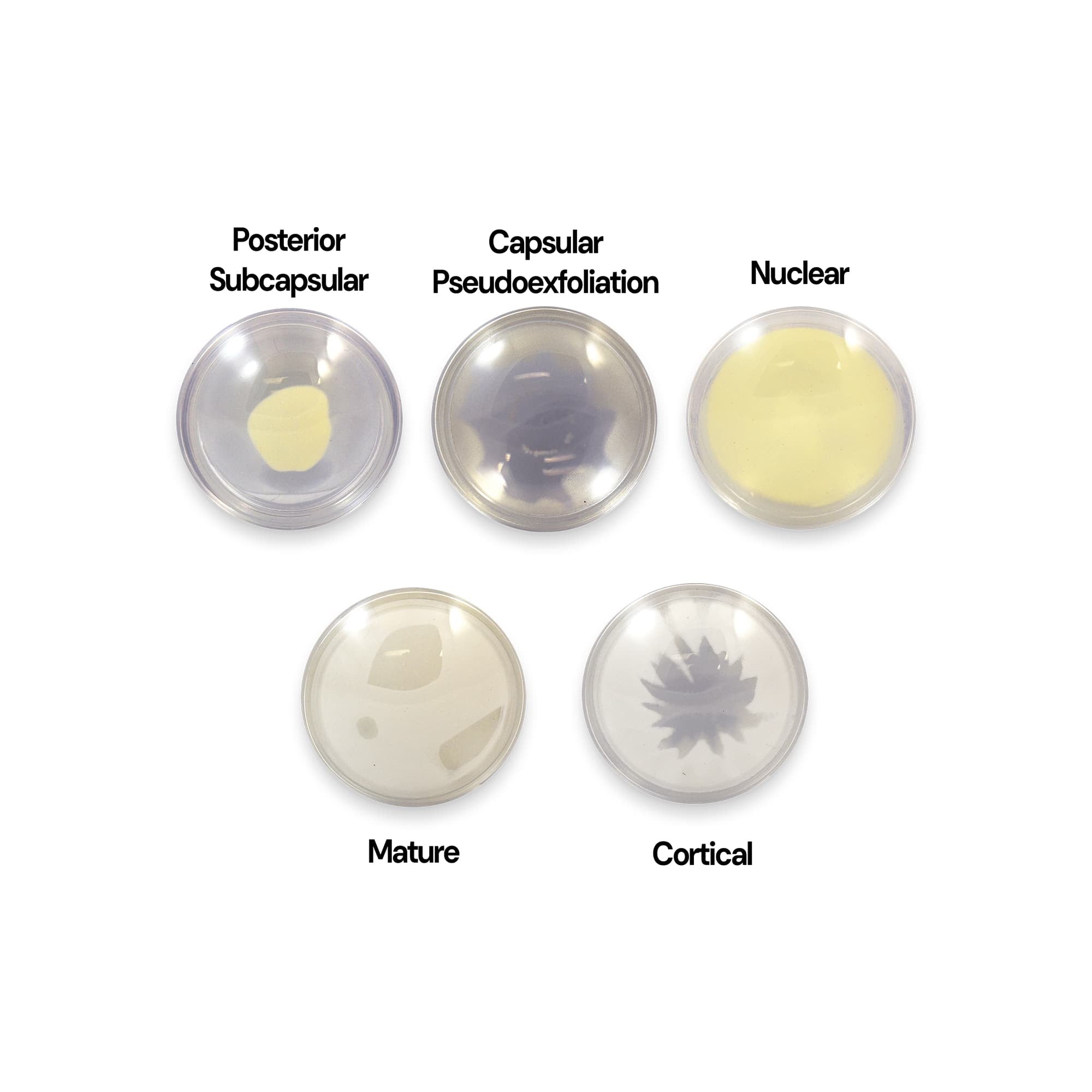 Good-Lite Educational Tools Eye Model: Cataract Lenses Set