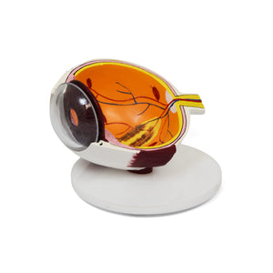 Good-Lite Educational Tools Eye Model: Vision Threatening Disease (VTD)