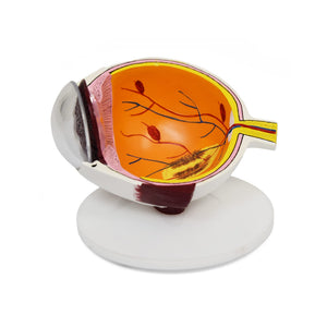 Good-Lite Educational Tools Eye Model: Vision Threatening Disease (VTD)