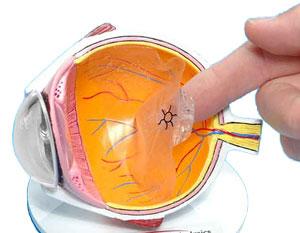 Good-Lite Retinal Detachment Eye Model